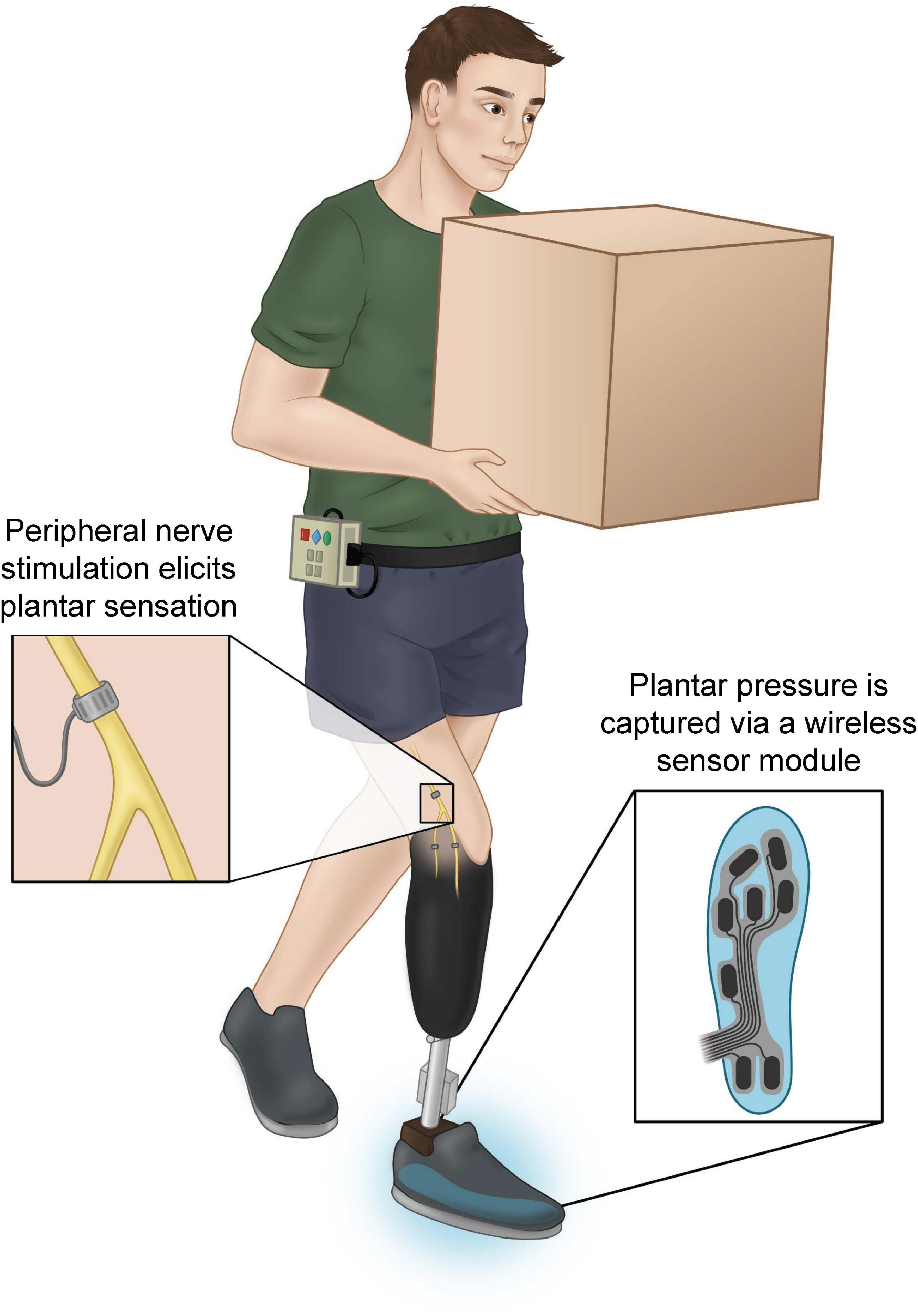 The experience of sensorimotor integration of a lower limb sensory neuroprosthesis: A qualitative case study